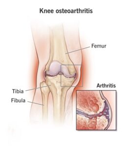 Osteoarthritis of Knee