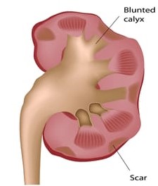 pyelonephritic kidney