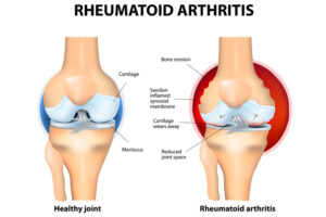 Rheumatoid arthritis of Knee