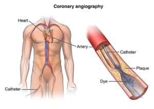 angiography