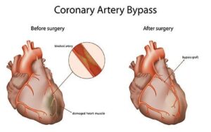 Coronary Artery Bypass Grafting (CABG)