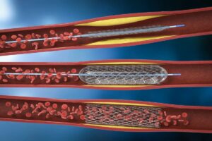 Angioplasty (stenting)