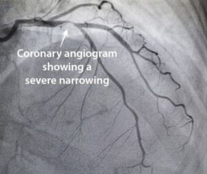 Coronary artery angiography