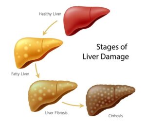 Liver disease
