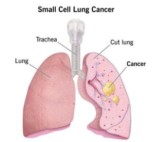 lungs cancer