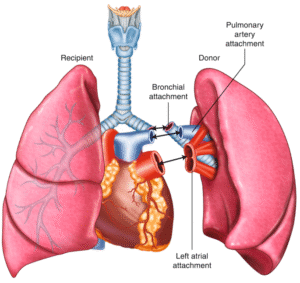 lungs transplant