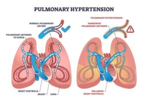 Pulmonary hypertension