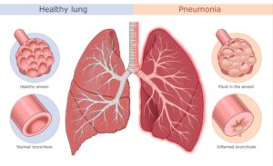 फेफड़ों के रोग  (Lungs diseases) pneumonia