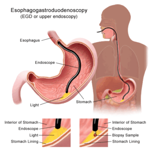 biopsy