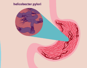 H pylori infection