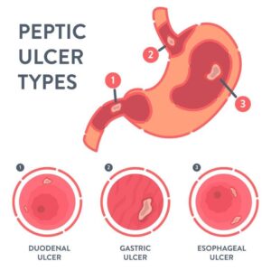 Peptic ulcer type