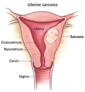 गर्भाशय कैंसर - uterine sarcoma