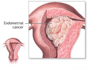 गर्भाशय कैंसर -endometrium cancer
