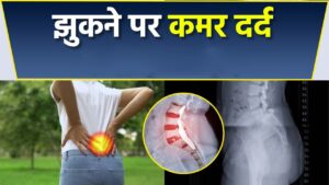 झुकी हुई कमर (Stooped posture)