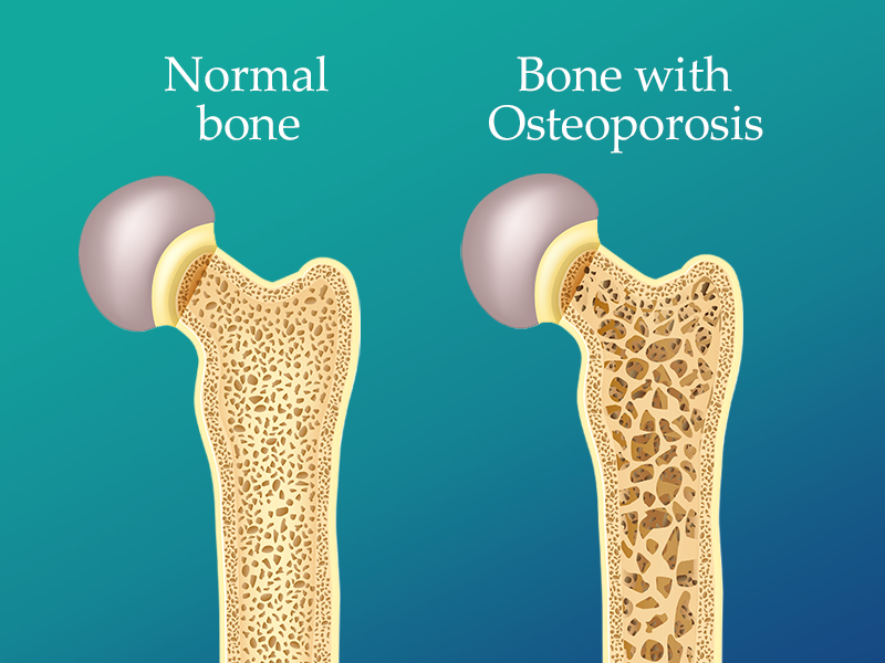 ऑस्टियोपोरोसिस (Osteoporosis) क्या है?
