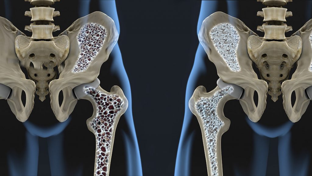 What is Osteoporosis ?